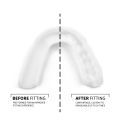Custom-Fit Dental Night Mouth Guard thumbnail
